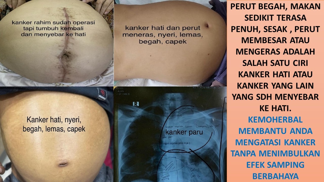 kemoherbal kanker rahim