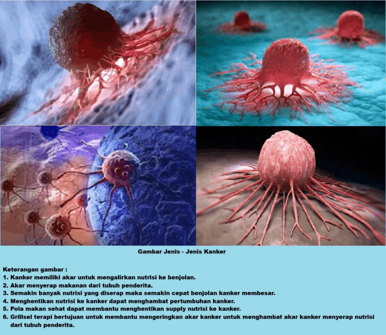 jenis kanker