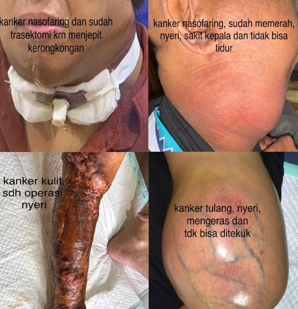 kemoherbal kanker