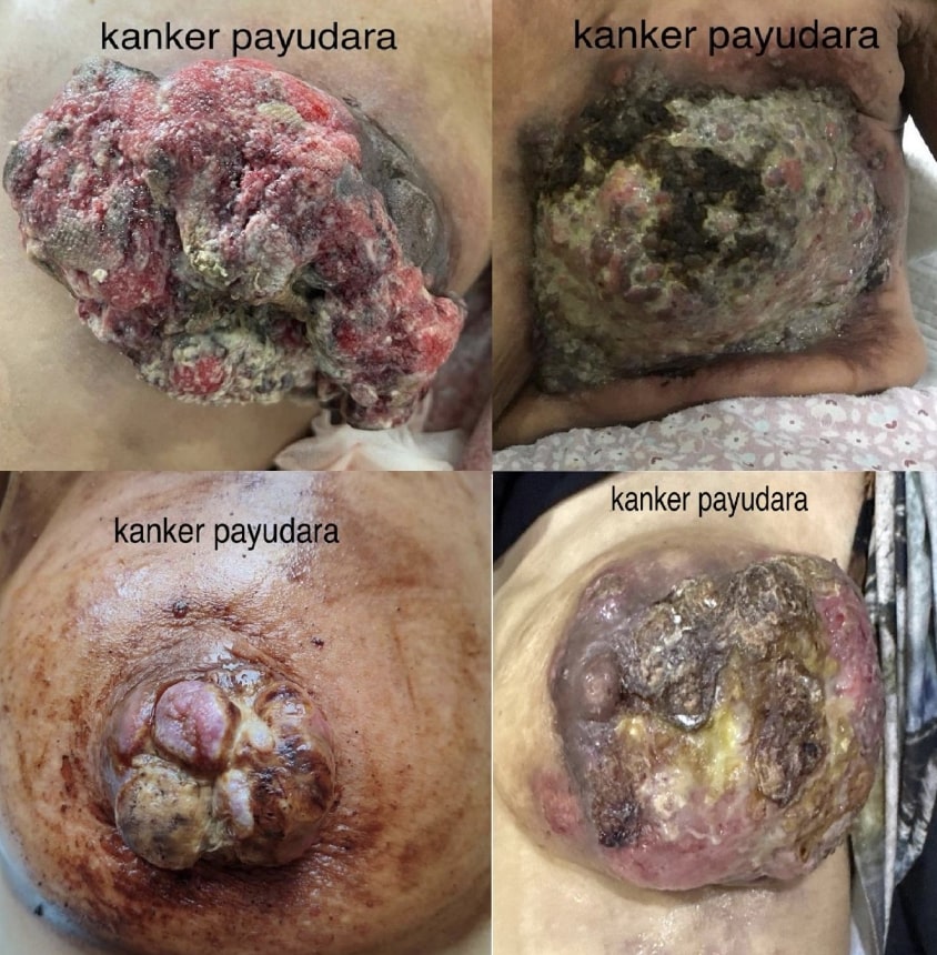 kemoherbal kanker payudara