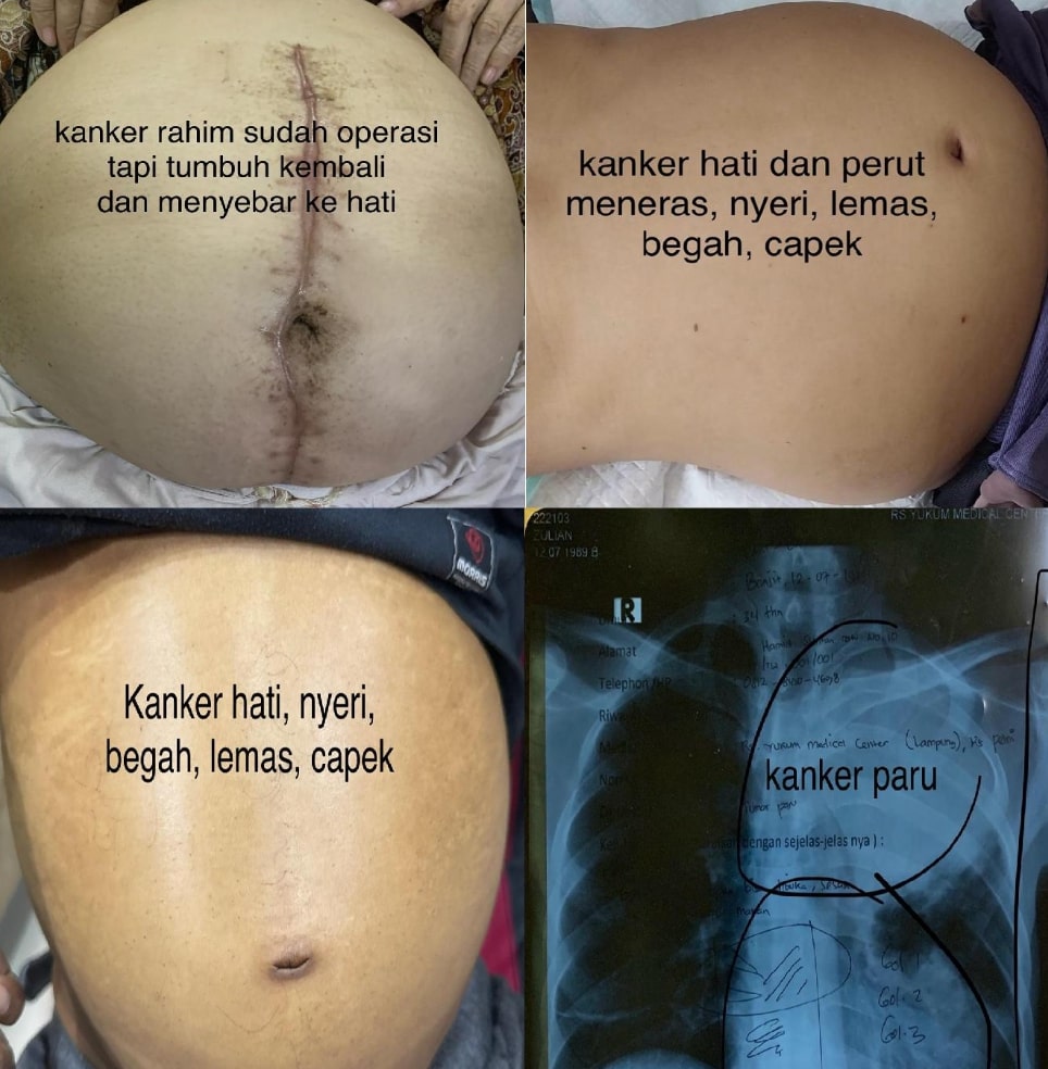 kemoherbal kanker rahim
