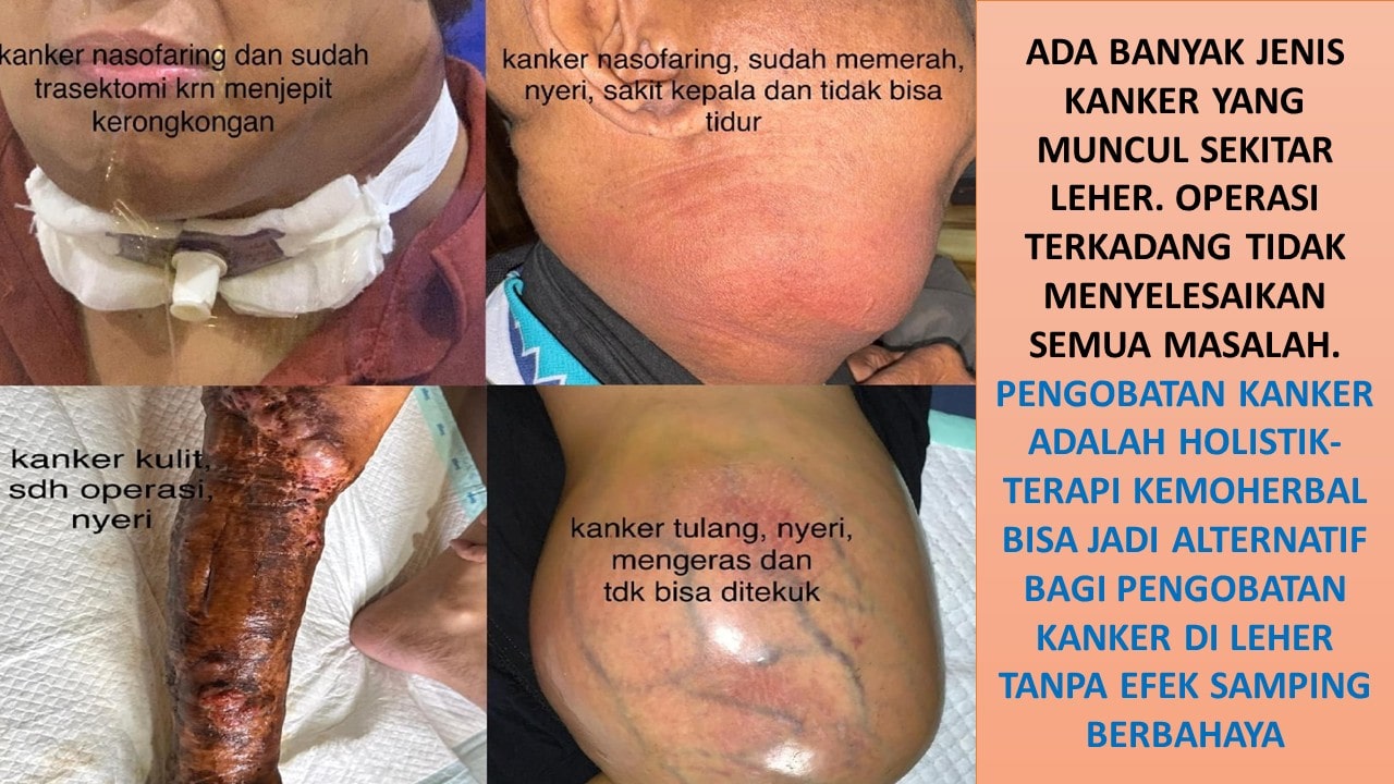 kemoherbal kanker
