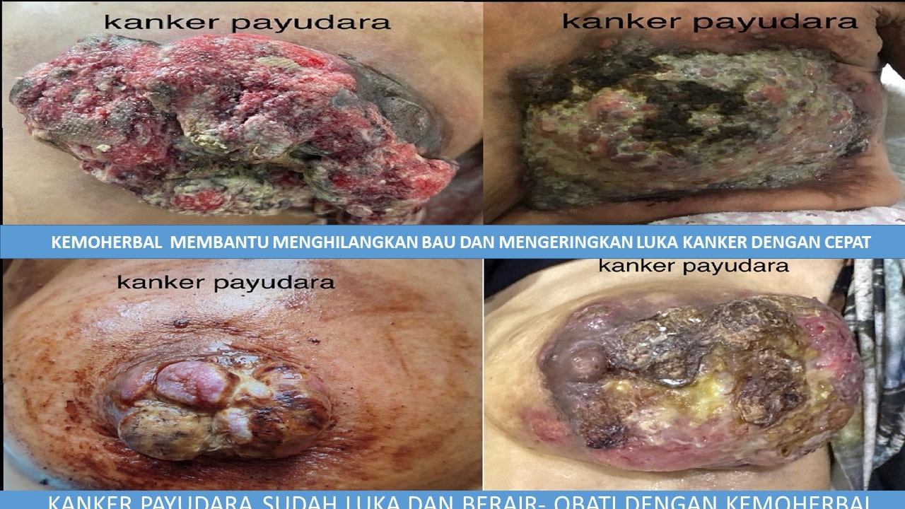 kemoherbal kanker payudara