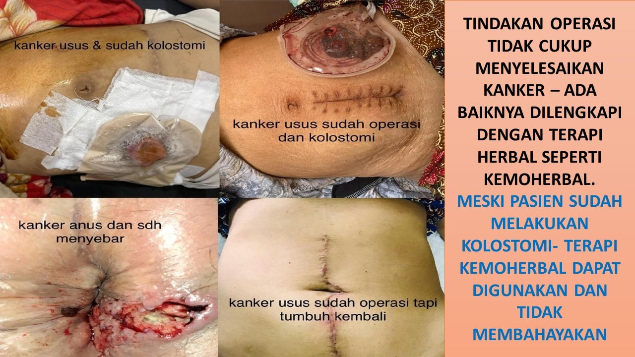 kemoherbal kanker